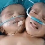 Best Indore News A girl with two heads and one torso was born in Indore