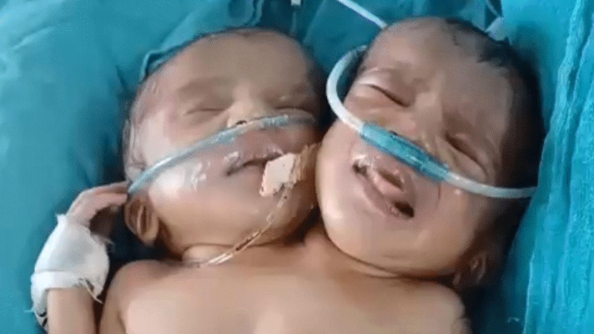 Best Indore News A girl with two heads and one torso was born in Indore