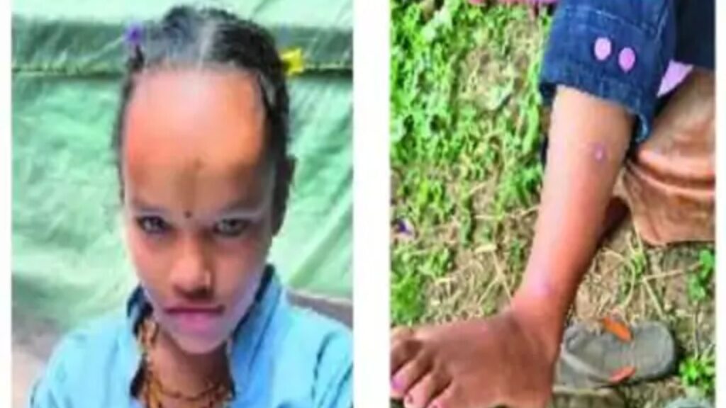 Best Indore News Due to zinc deficiency in Jhabua, 36% people