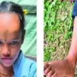 Best Indore News Due to zinc deficiency in Jhabua, 36% people